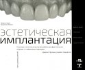 Эстетическая имплантация. Сложные клинические случаи работы во фронтальных отделах с глобальным подходом к реконструкции улыбки пациента